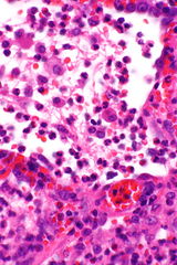 Acute infectious pneumonia - Libre Pathology