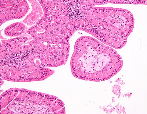 Papillary cystadenoma lymphomatosum3.jpg