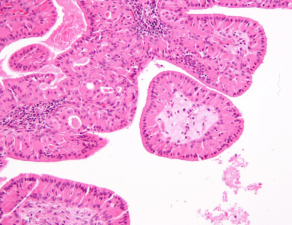 File:Papillary cystadenoma lymphomatosum3.jpg