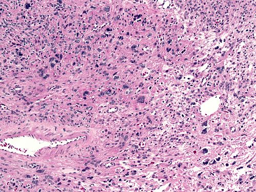 Atypical leiomyoma with bizarre nuclei high magnification.jpg