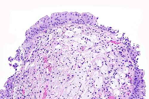Urinary bladder xanthoma -- intermed mag.jpg
