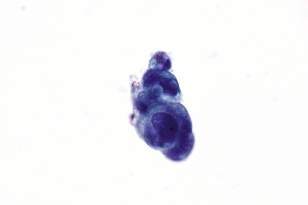 Adenocarcinoma - Pap test -- very high mag.gif