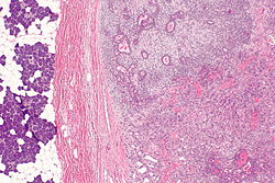 Carcinoma ex pleomorphic adenoma -- low mag.jpg