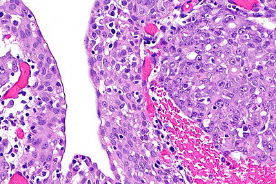 Renal medullary carcinoma - 2 -- high mag.jpg