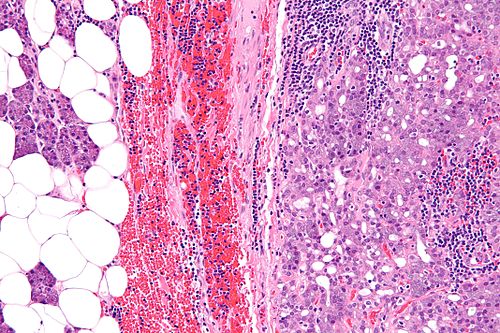 Acinic cell carcinoma - high mag.jpg
