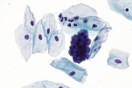 Endometrial cells on Pap - 2a -- very high mag.gif
