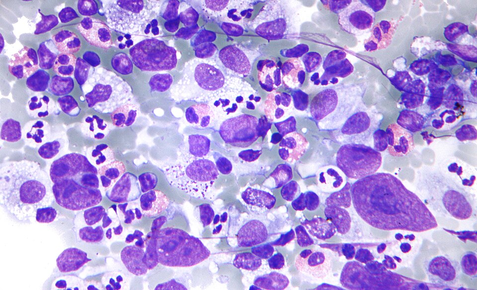 File:Hodgkin lymphoma cytology small.jpg