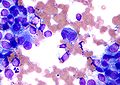 Melanoma - cytology field stain.jpg