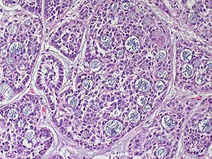 adenoid cystic carcinoma pathology)