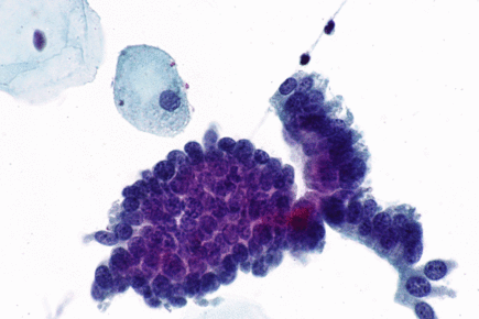 Endocervical adenocarcinoma in situ - cyto -- very high mag.gif