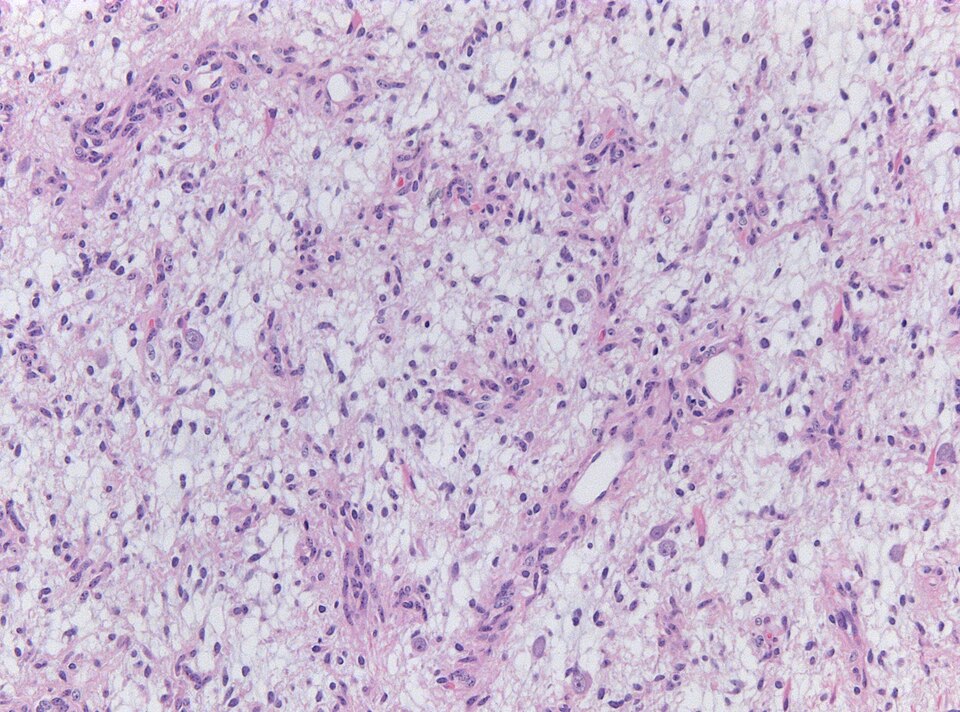 File:Neuropathology case V 02.jpg