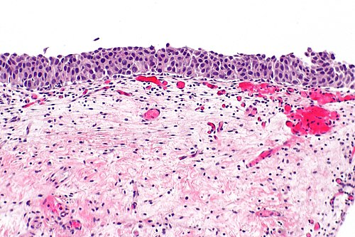 Urothelial carcinoma in situ -- intermed mag.jpg