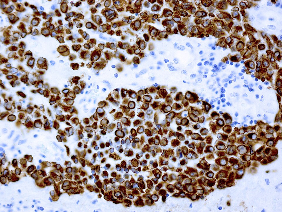 File:Crooke Cytokeratins.jpg