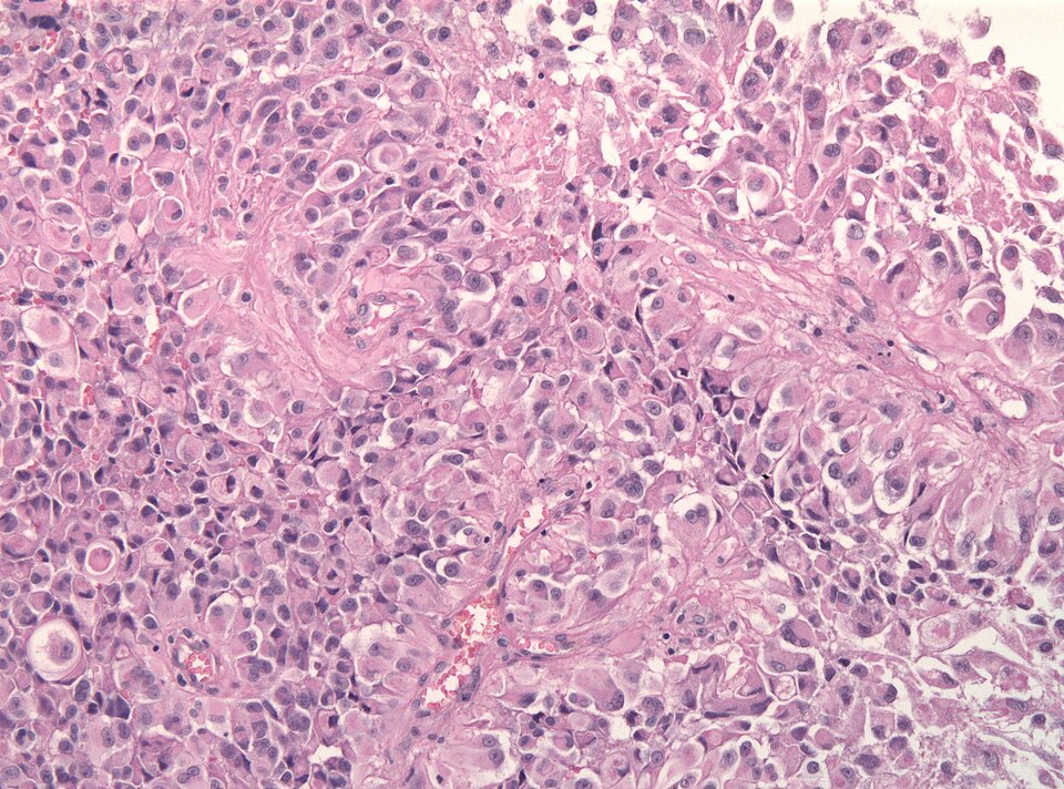 File:Epitheloid glioblastoma HE.jpg
