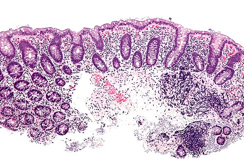 Intestinal spirochetosis - intermed mag.jpg