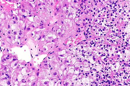TFEB-rearranged renal cell carcinoma - Libre Pathology