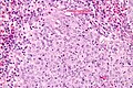 Glassy cell carcinoma - very high mag.jpg