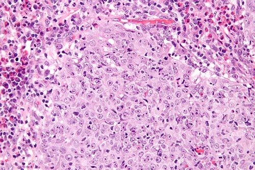Glassy cell carcinoma - very high mag.jpg