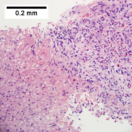 Fibrinopurulent exudate apposes granulation tissue (200X).