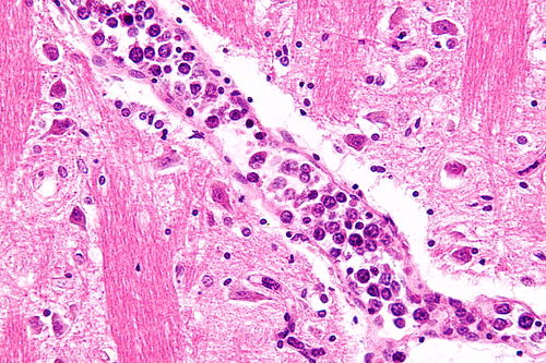 Intravascular lymphoma - very high mag.jpg