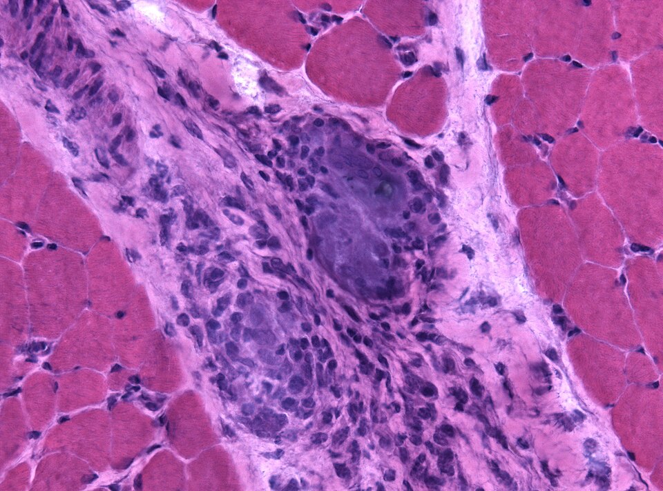File:Sarkoidosis muscle.jpg