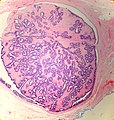 intraductal papilloma libre pathology condilom al mucoasei vaginale