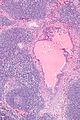 Endosalpingiosis in lymph node - intermed mag.jpg