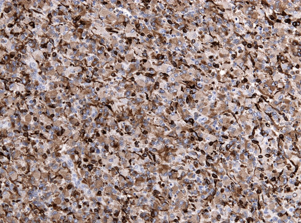 File:Neuropathology case IX 05.jpg