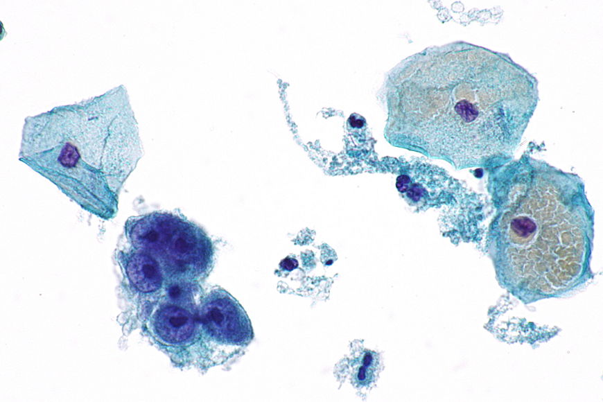Nilm цитология что это такое. Nilm цитология что это. Цитопатология зараженных клеток. ASCUS цитологическая картина заболевания.