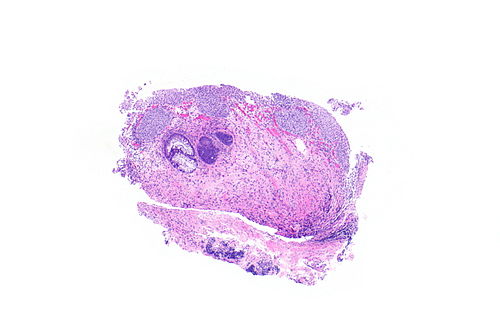Cystitis cystica et glandularis -- very low mag.jpg