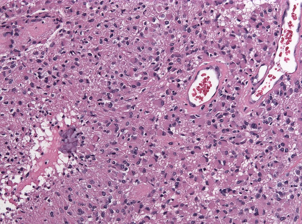 File:Neuropathology case IX 02.jpg