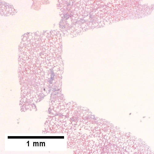Steatosis afflicts almost all hepatocytes (pan-acinar) (Row 1 Left 40X).
