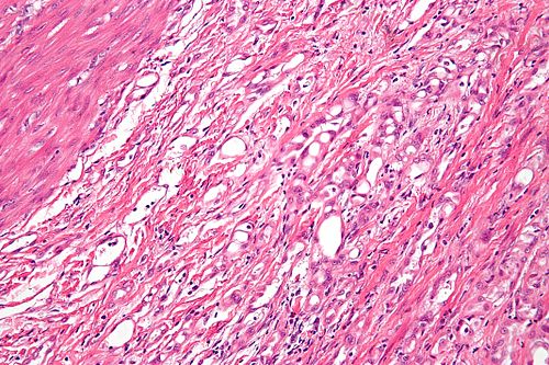 Adenomatoid tumour - high mag.jpg