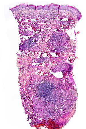 necrobiosis lipoidica pathology)
