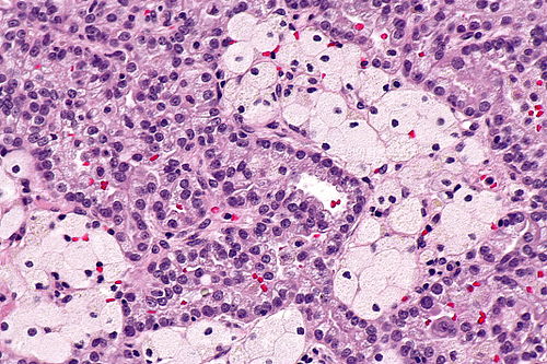 Papillary renal cell carcinoma - 2 -- high mag.jpg