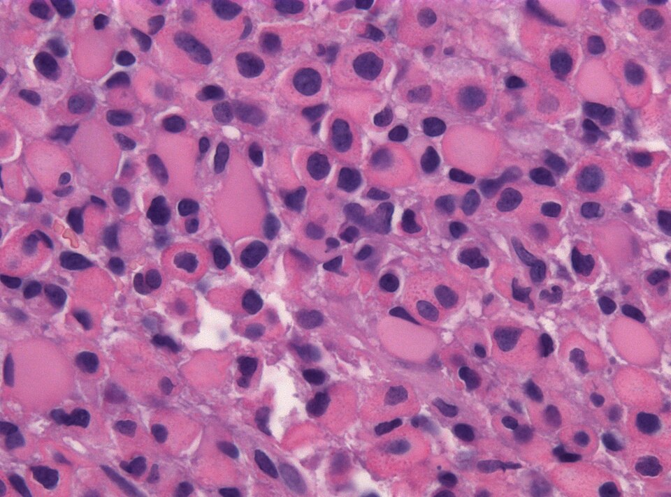 File:Gemistocytic astrocytoma.jpg