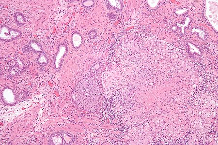 Granulation tissue - Libre Pathology