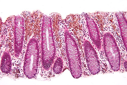 Melanosis coli intermed mag.jpg