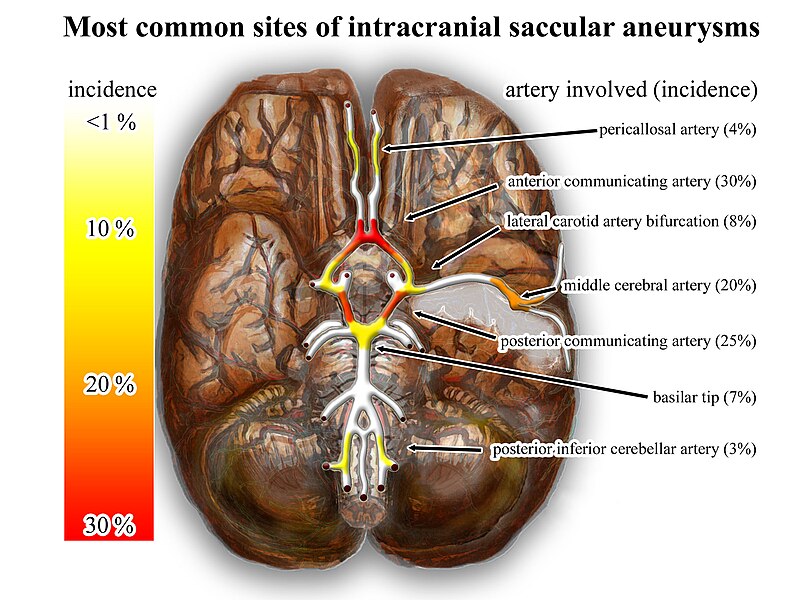 Distribution of cerebral aneurysms (Nicholas Zaorsky, M.D.)