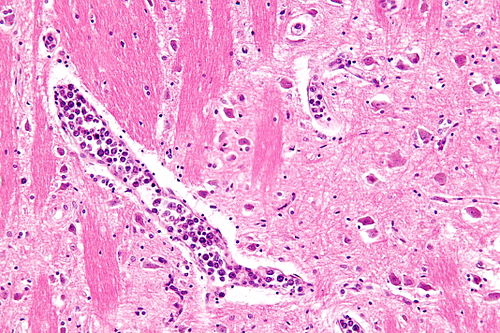 Intravascular lymphoma - high mag.jpg