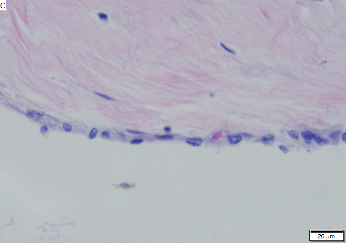 Microcystic serous cystadenoma of pancreas