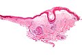 Lichen sclerosus - low mag.jpg