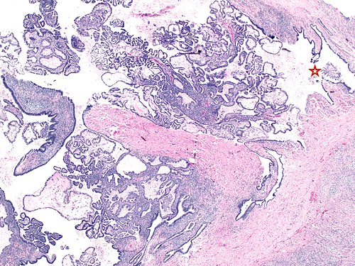 Low maginification of borderline serous tumor of the ovary.jpg