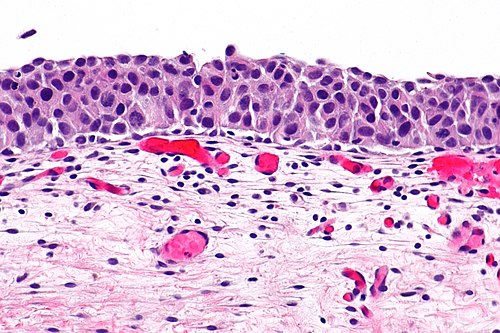 Urothelial carcinoma in situ -- high mag.jpg
