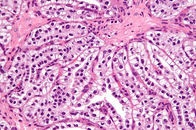 Clear cell papillary renal cell carcinoma - very high mag.jpg