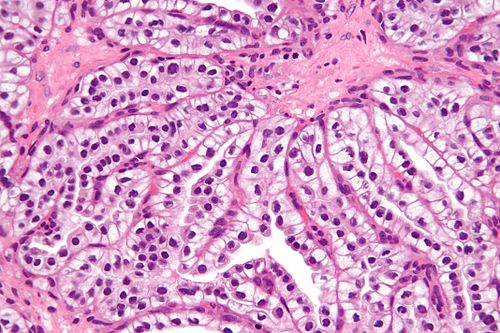 Clear cell papillary renal cell carcinoma - very high mag.jpg