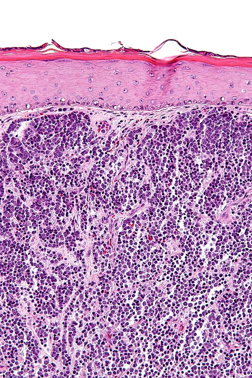 Merkel cell carcinoma - high mag.jpg