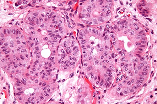 Nested variant of urothelial carcinoma - very high mag.jpg