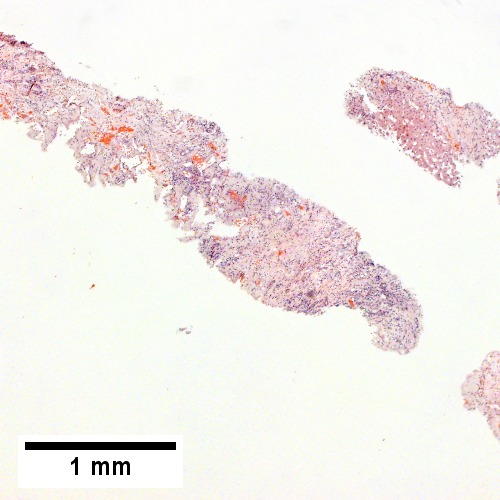 Fibrous foci with increased spaces, hepatocyte focus with nonspecific fibrotic bridge (40X).