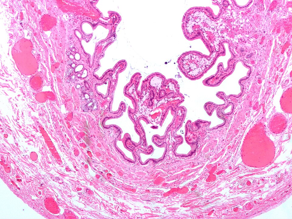 File:Gallbladder cholesterolosis micro.jpg